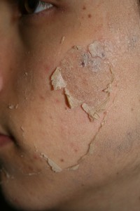 2Peeling-During