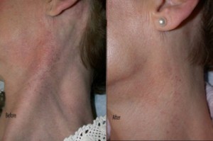 Before and After `2