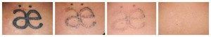Before and After - 10 treatments