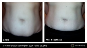 Before and After - Body Contouring 4
