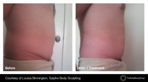 Before and After - Body Contouring 5