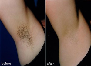 Hair Reduction 3