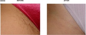Hair Reduction 4