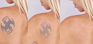Laser tattoo removal befor and after. Beautiful young woman with tattoo on her back