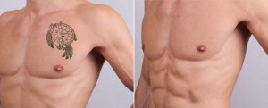 Laser tattoo removal before and after. Attractive Man with tattoo on his chest